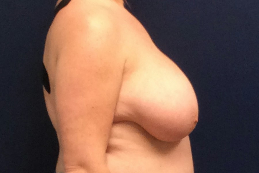 Patient 23320 | Profile View | Before — Dr. Tommaso Addona -