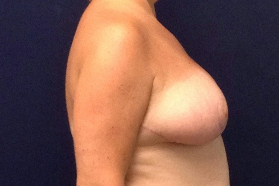 Patient 23320 | Profile View | After — Dr. Tommaso Addona -