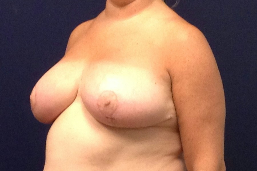 Patient 23320 | Angle View | After — Dr. Tommaso Addona -