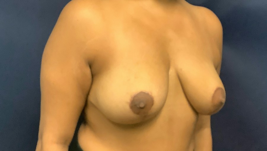 Patient 22652 | Angle View | After — Dr. Tommaso Addona -