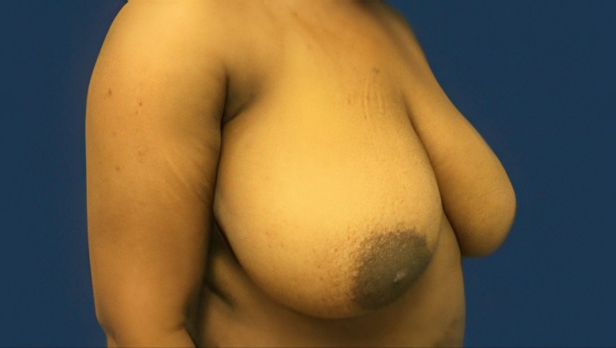 Patient 22358 | Angle View | Before — Dr. Tommaso Addona -