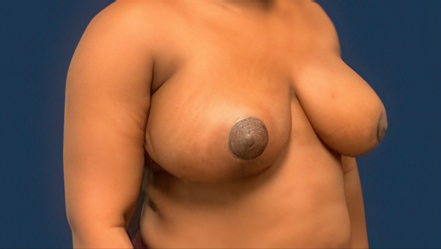 Patient 22358 | Angle View | After — Dr. Tommaso Addona -