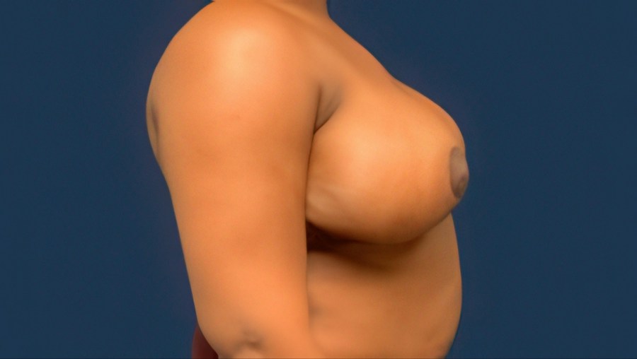 Patient 22358 | Profile View | After — Dr. Tommaso Addona -