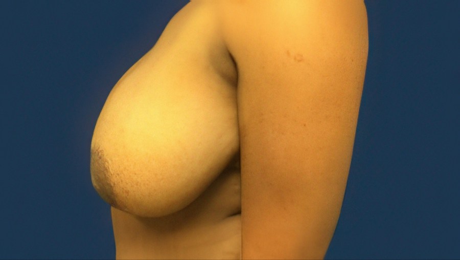 Patient 22358 | Profile View | Before — Dr. Tommaso Addona -