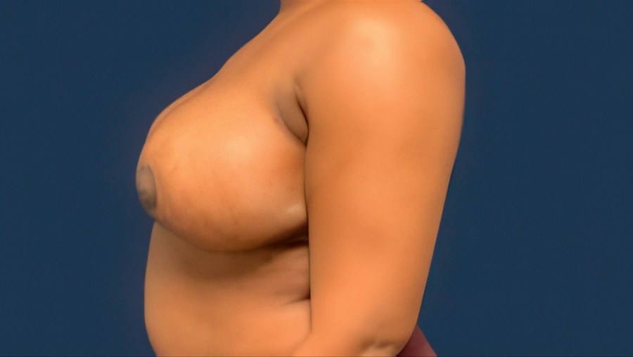 Patient 22358 | Profile View | After — Dr. Tommaso Addona -