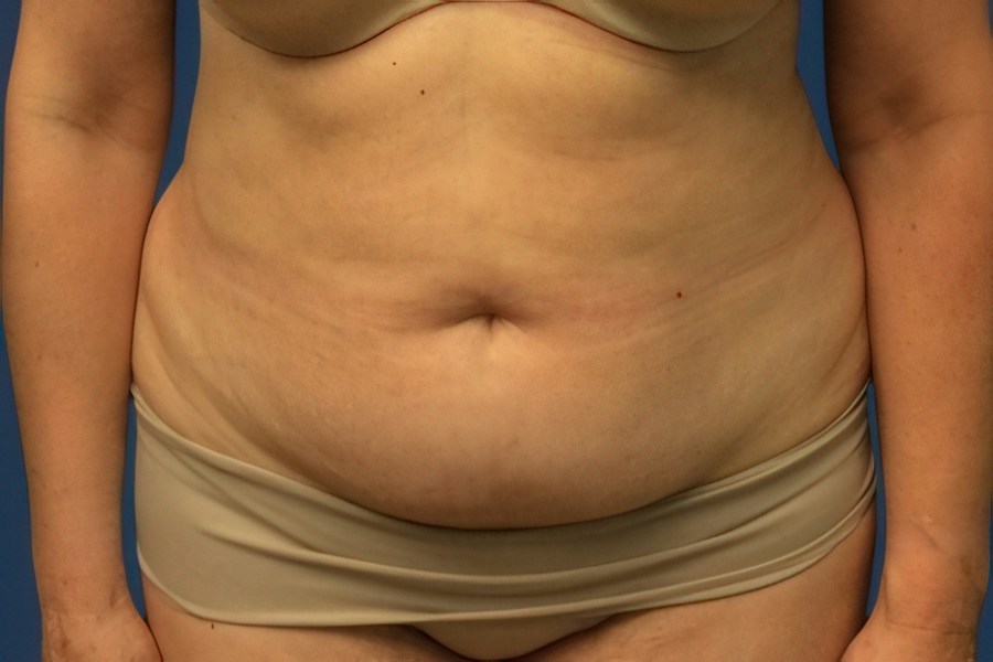 Patient 80687 | Front View | Before — Dr. Tommaso Addona -