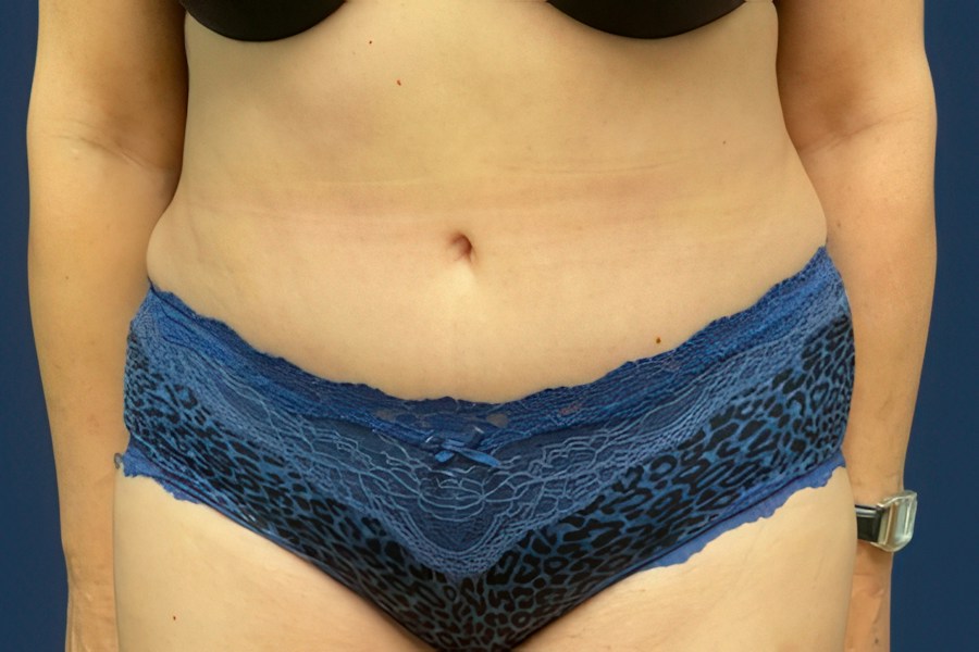 Patient 80687 | Front View | After — Dr. Tommaso Addona -