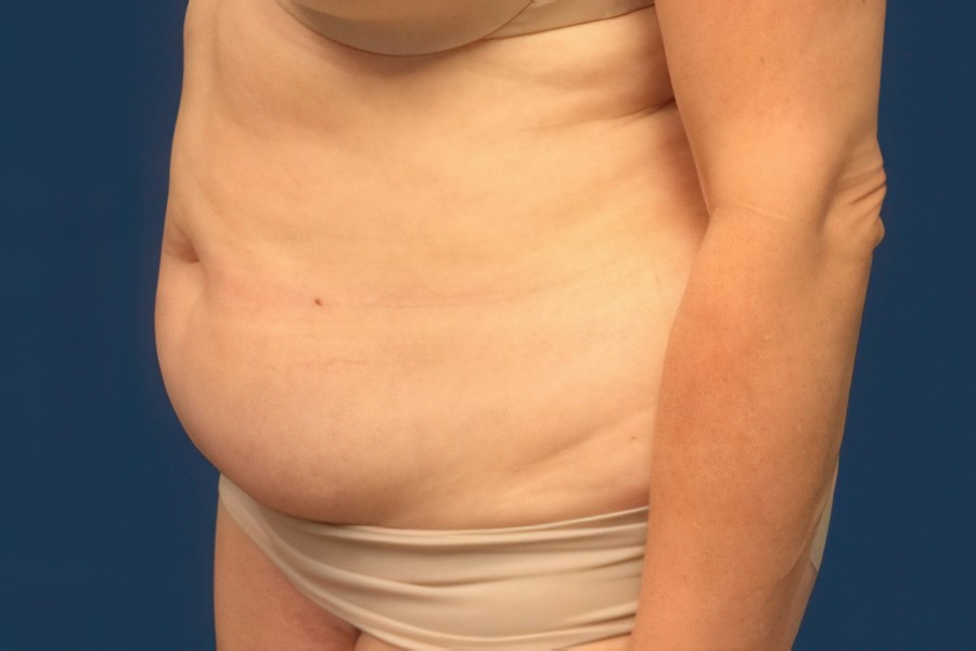 Patient 80687 | Angle View | Before — Dr. Tommaso Addona -