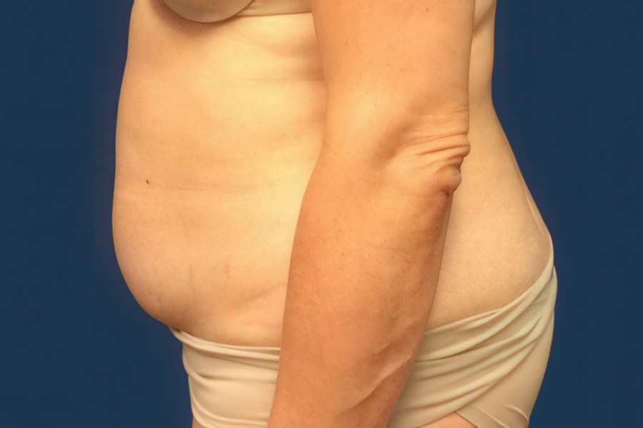 Patient 80687 | Profile View | Before — Dr. Tommaso Addona -