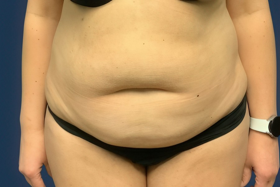 Patient 80686 | Front View | Before — Dr. Tommaso Addona -