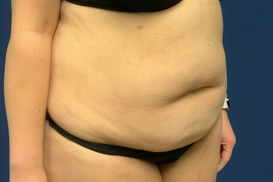 Patient 80686 | Angle View | Before — Dr. Tommaso Addona -