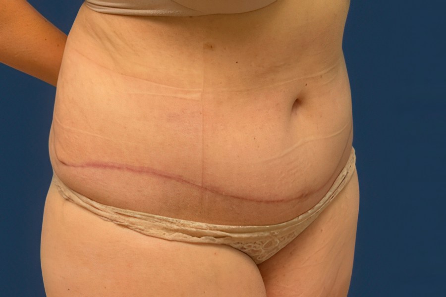 Patient 80686 | Angle View | After — Dr. Tommaso Addona -