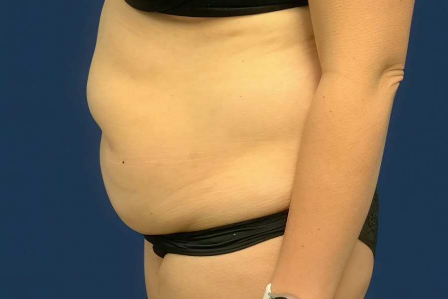 Patient 80686 | Profile View | Before — Dr. Tommaso Addona -