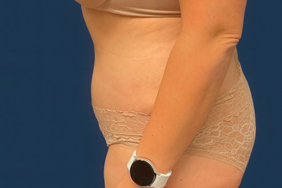 Patient 80686 | Profile View | After — Dr. Tommaso Addona -