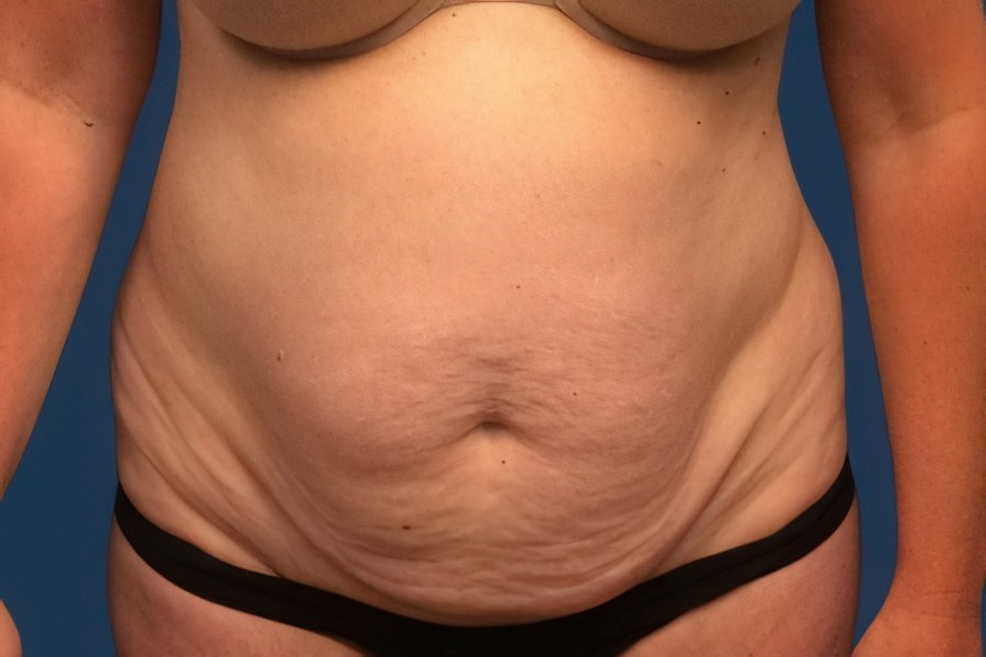 Patient 79444 | Front View | Before — Dr. Tommaso Addona -