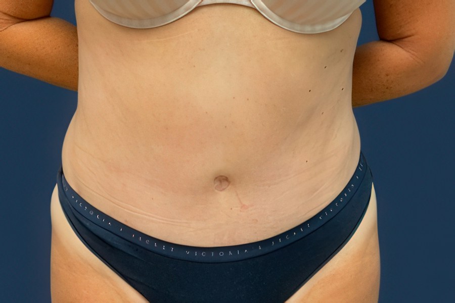 Patient 79444 | Front View | After — Dr. Tommaso Addona -