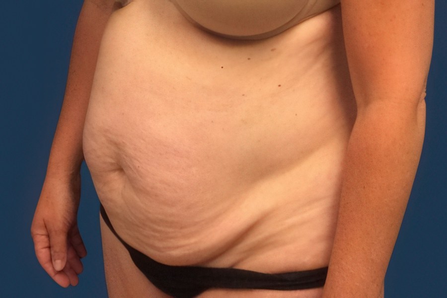 Patient 79444 | Angle View | Before — Dr. Tommaso Addona -