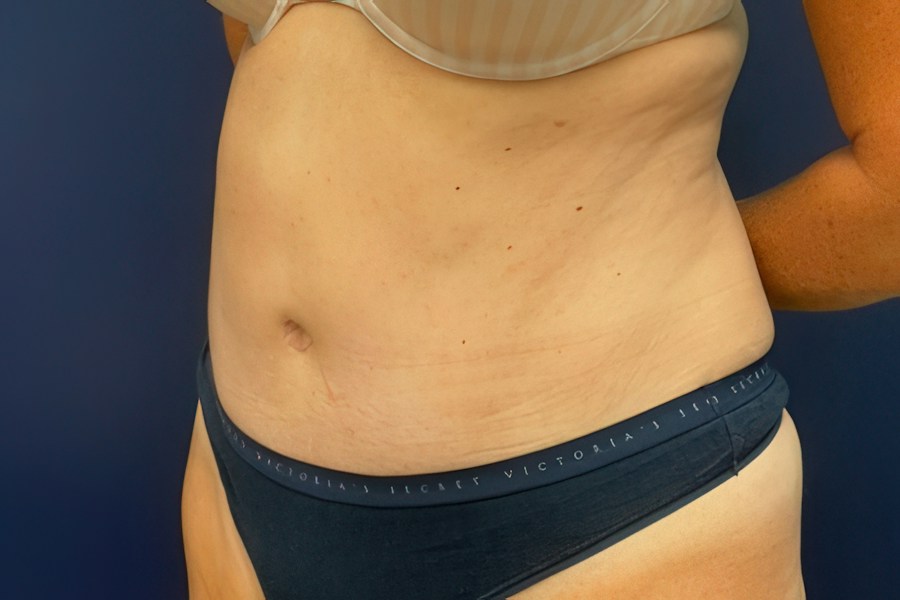 Patient 79444 | Angle View | After — Dr. Tommaso Addona -