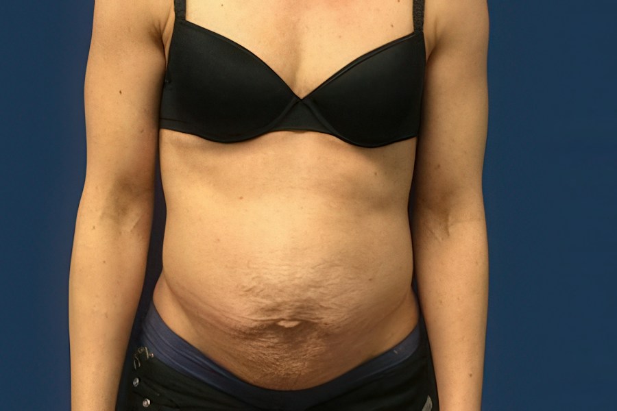 Patient 50294 | Front View | Before — Dr. Tommaso Addona -