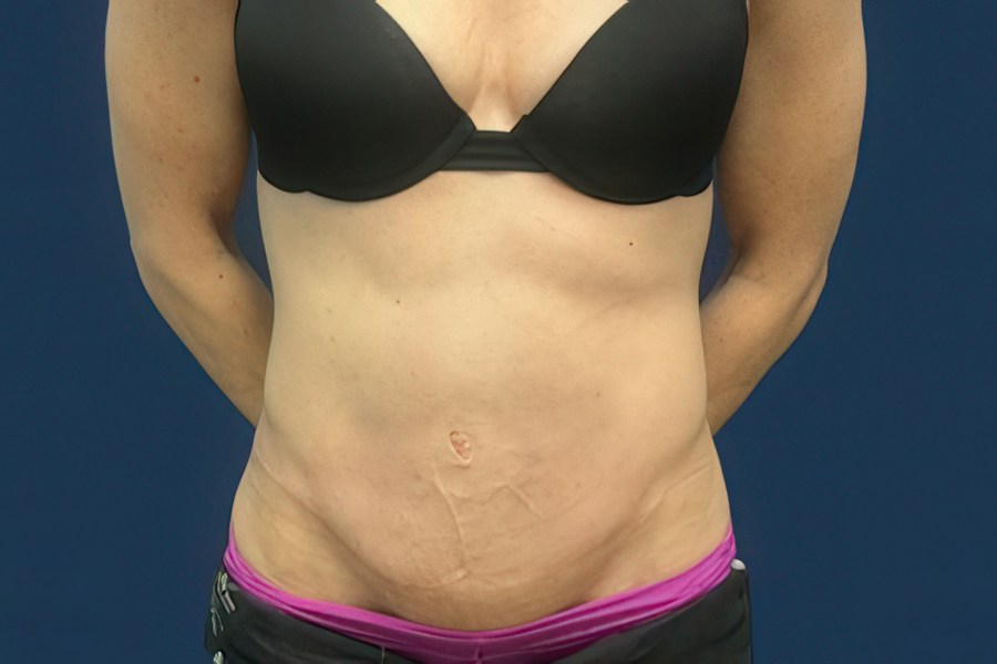 Patient 50294 | Front View | After — Dr. Tommaso Addona -