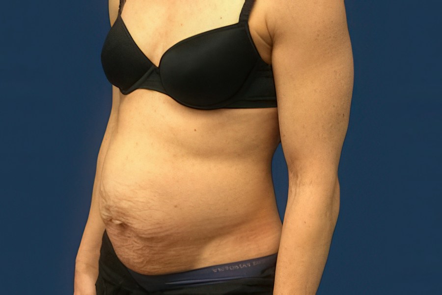 Patient 50294 | Angle View | Before — Dr. Tommaso Addona -