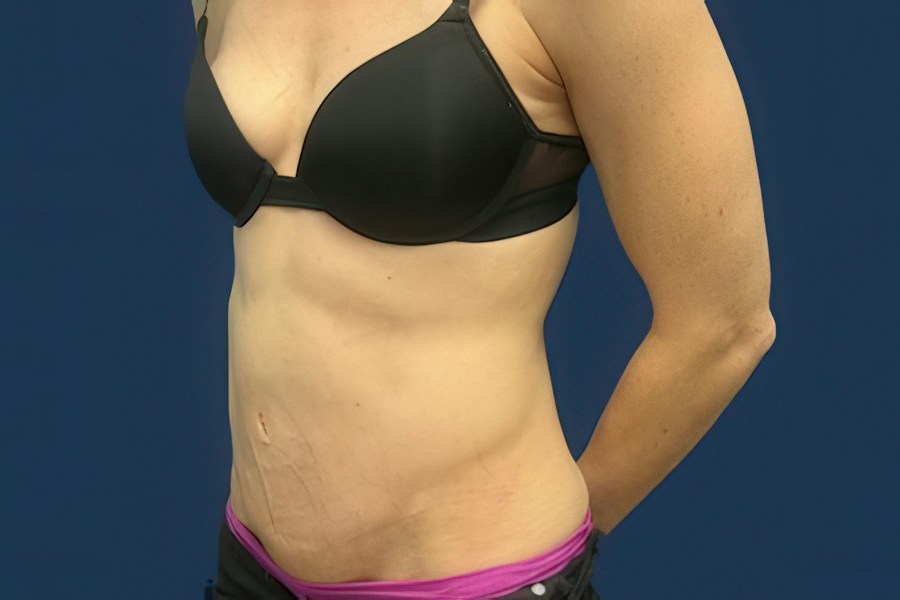 Patient 50294 | Angle View | After — Dr. Tommaso Addona -
