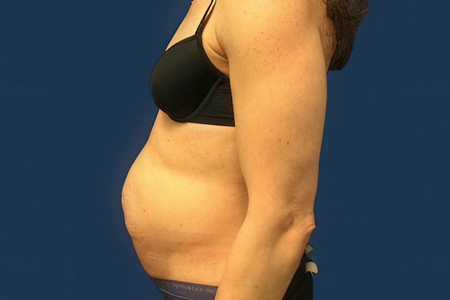 Patient 50294 | Profile View | Before — Dr. Tommaso Addona -