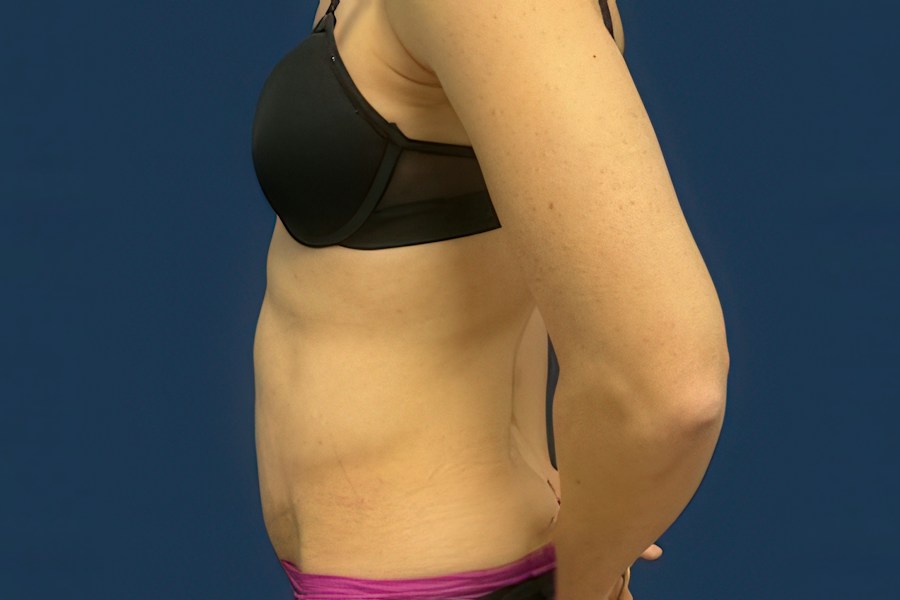 Patient 50294 | Profile View | After — Dr. Tommaso Addona -