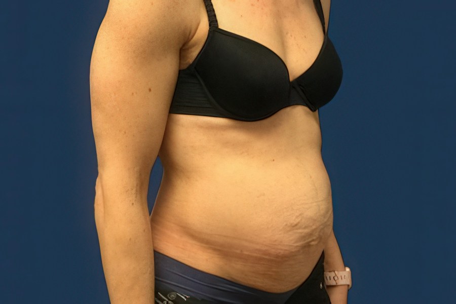 Patient 50294 | Angle View | Before — Dr. Tommaso Addona -