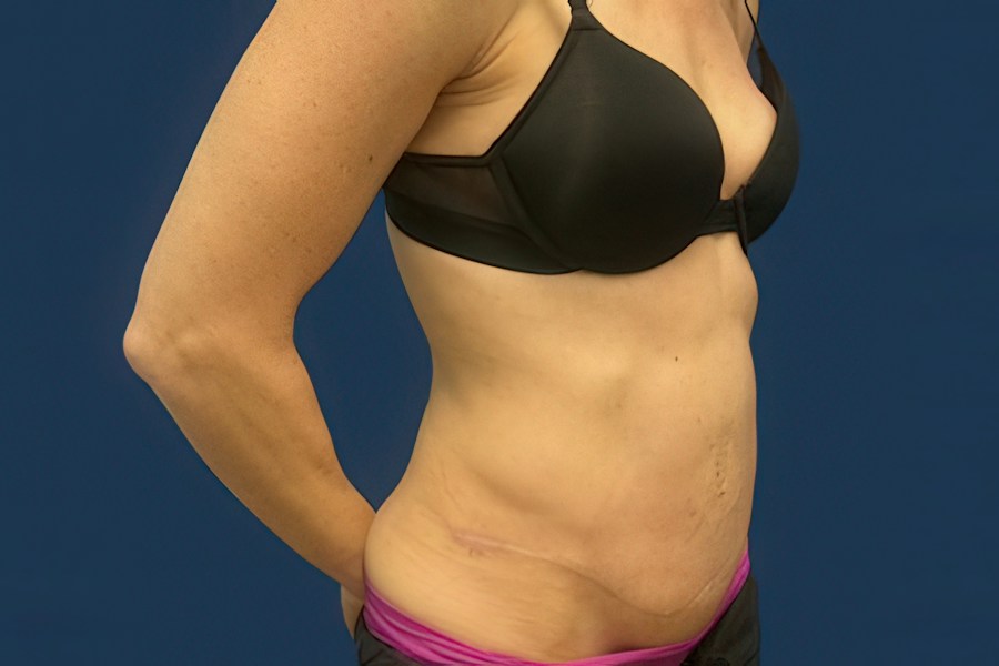 Patient 50294 | Angle View | After — Dr. Tommaso Addona -