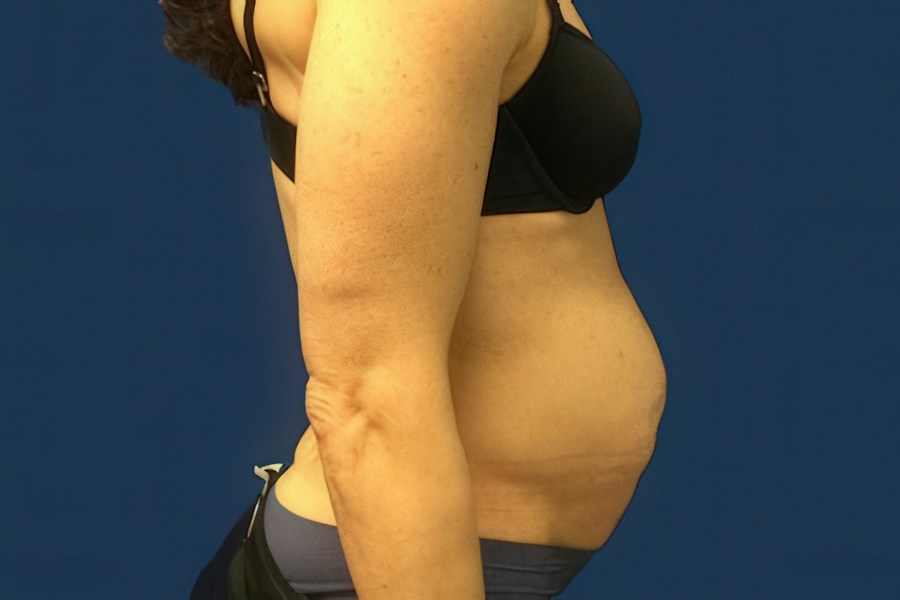 Patient 50294 | Profile View | Before — Dr. Tommaso Addona -