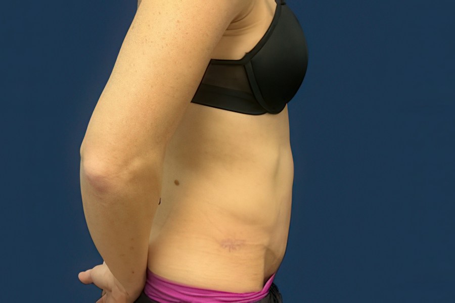 Patient 50294 | Profile View | After — Dr. Tommaso Addona -