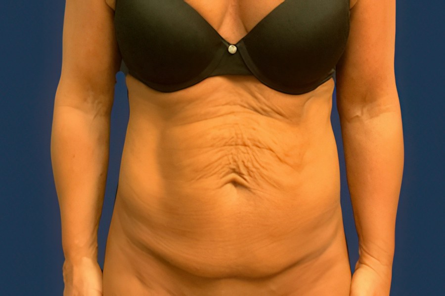 Patient 46679 | Front View | Before — Dr. Tommaso Addona -