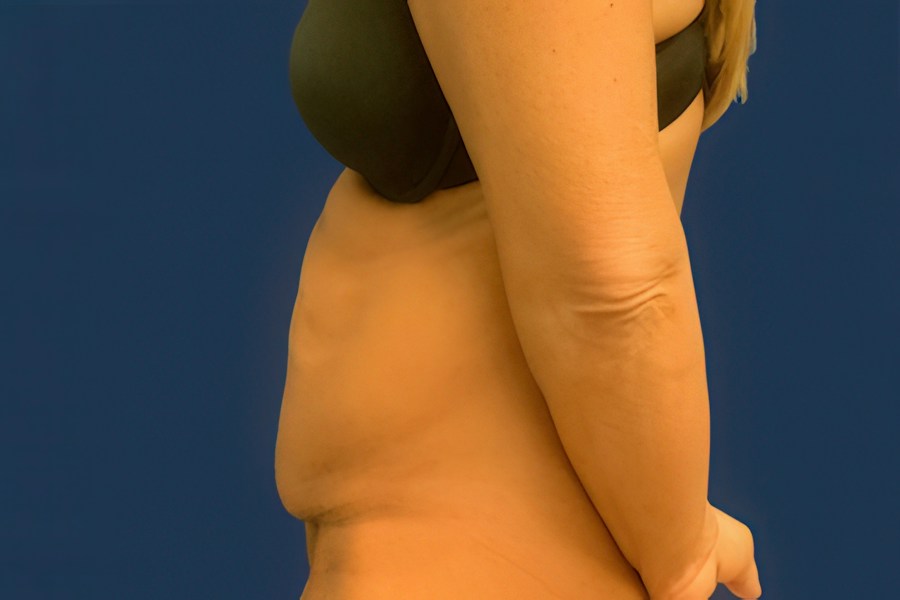 Patient 46679 | Profile View | Before — Dr. Tommaso Addona -