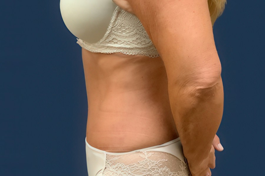Patient 46679 | Profile View | After — Dr. Tommaso Addona -