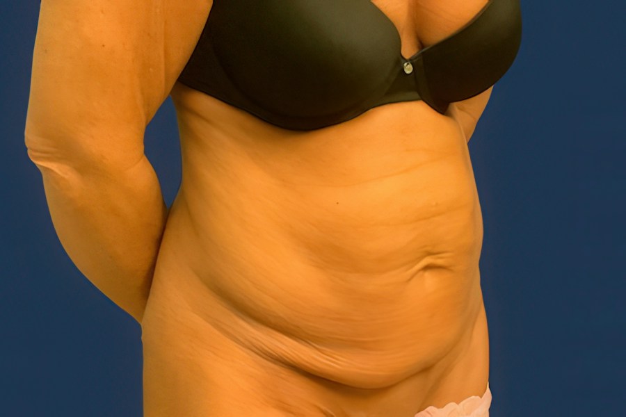 Patient 46679 | Angle View | Before — Dr. Tommaso Addona -
