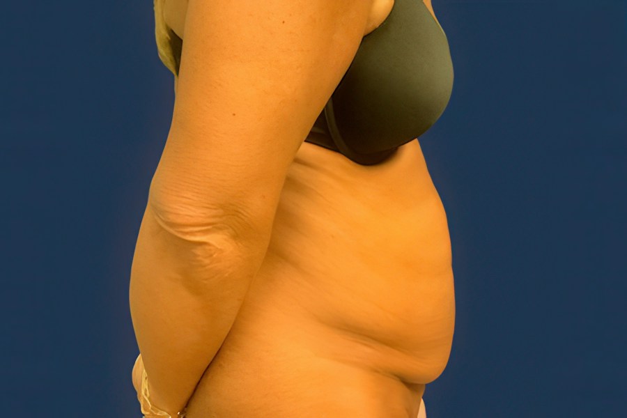 Patient 46679 | Profile View | Before — Dr. Tommaso Addona -