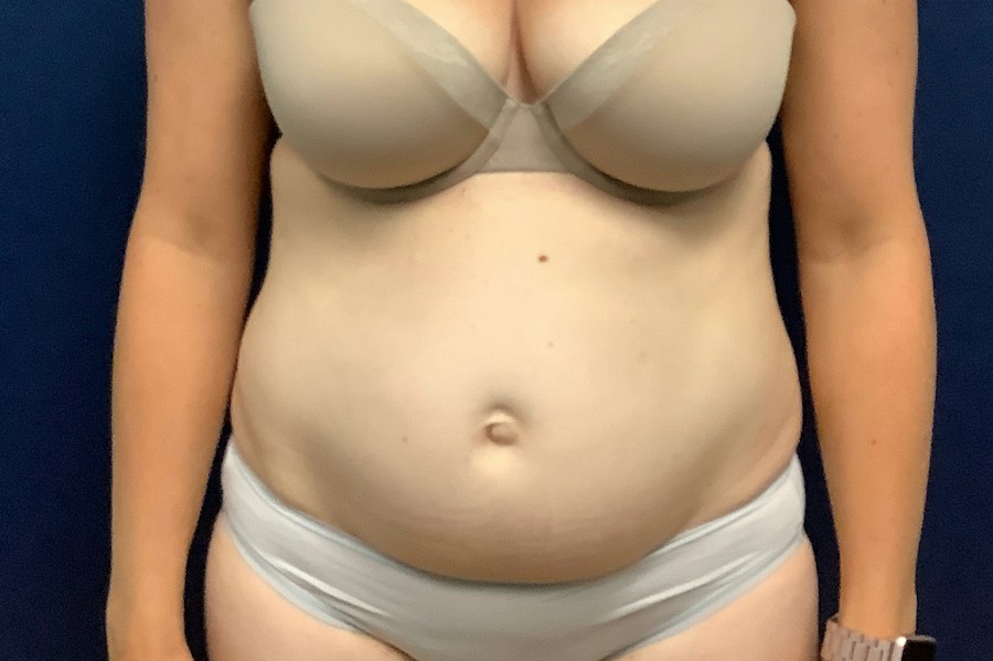 Patient 26967 | Front View | Before — Dr. Tommaso Addona -