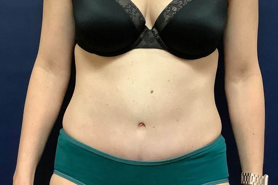 Patient 26967 | Front View | After — Dr. Tommaso Addona -