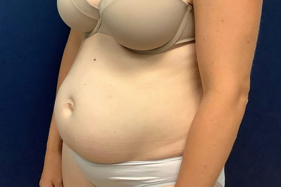 Patient 26967 | Angle View | Before — Dr. Tommaso Addona -