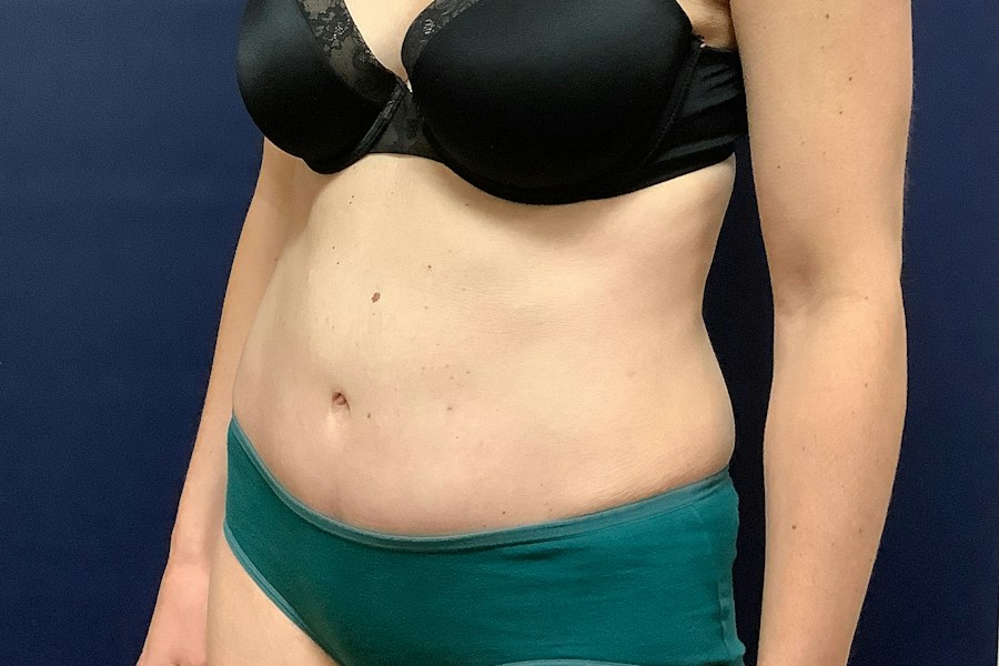 Patient 26967 | Angle View | After — Dr. Tommaso Addona -