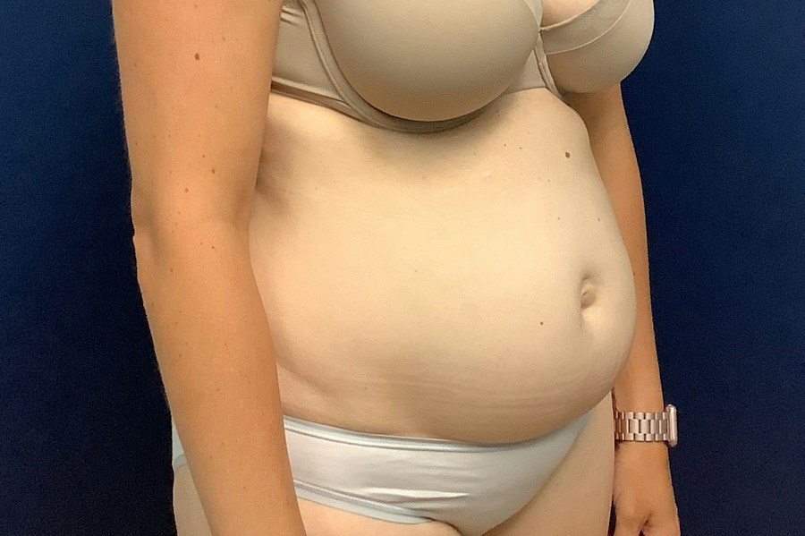 Patient 26967 | Angle View | Before — Dr. Tommaso Addona -