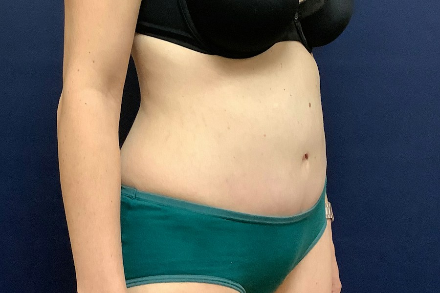 Patient 26967 | Angle View | After — Dr. Tommaso Addona -