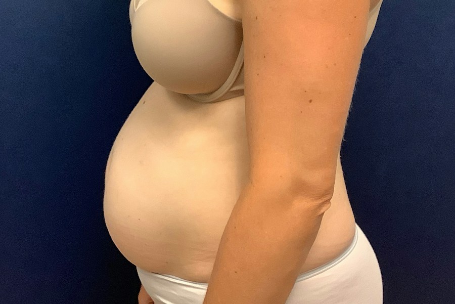 Patient 26967 | Profile View | Before — Dr. Tommaso Addona -