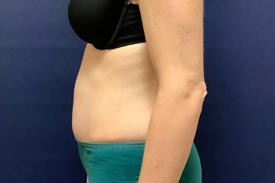 Patient 26967 | Profile View | After — Dr. Tommaso Addona -