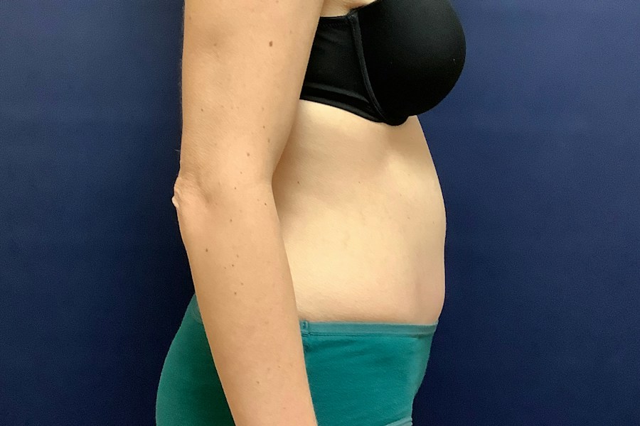 Patient 26967 | Profile View | After — Dr. Tommaso Addona -