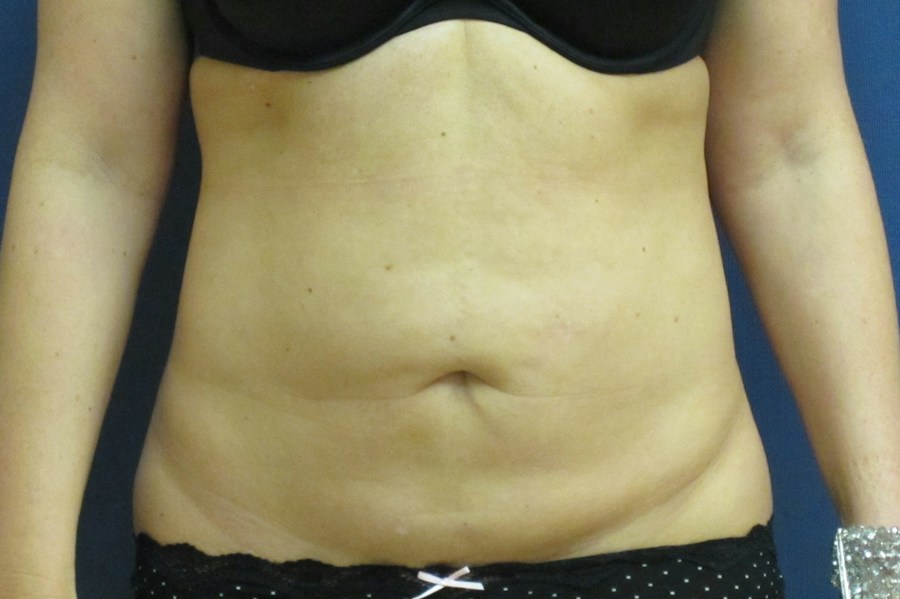 Patient 13664 | Front View | Before — Dr. Tommaso Addona -