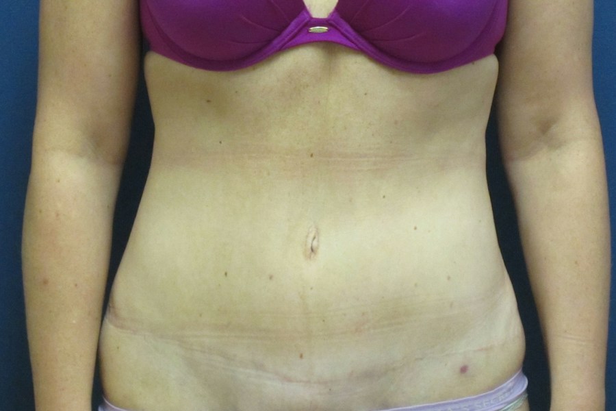 Patient 13664 | Front View | After — Dr. Tommaso Addona -