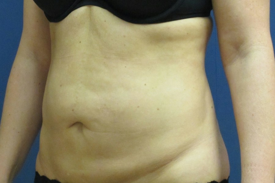 Patient 13664 | Angle View | Before — Dr. Tommaso Addona -