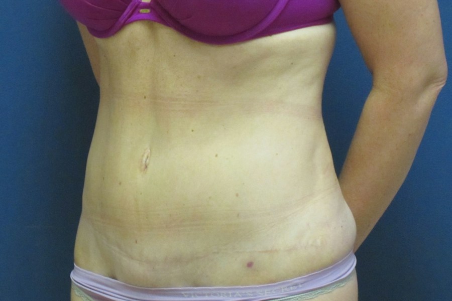 Patient 13664 | Angle View | After — Dr. Tommaso Addona -